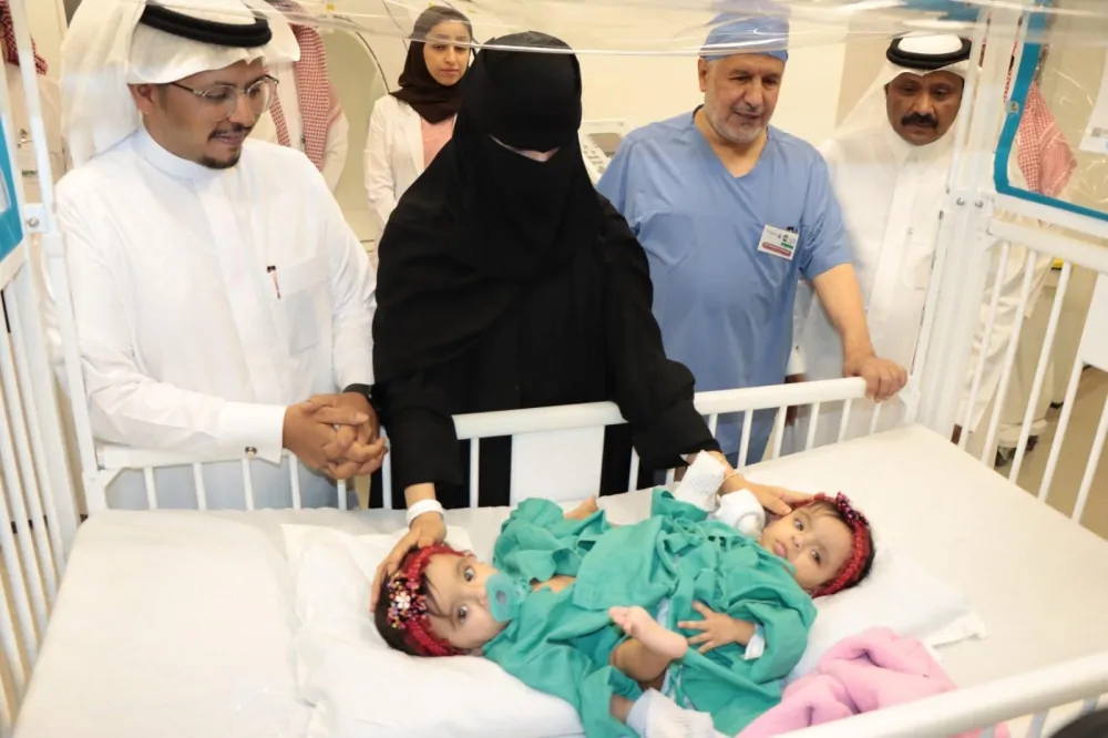 انطلاق المرحلة الثانية من فصل التوأم السعودي يارا ولارا الملتصقين