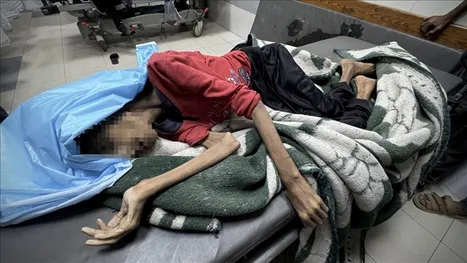 العالم أمام مسؤولية عاجلة: أطفال غزة يواجهون الموت جوعًا